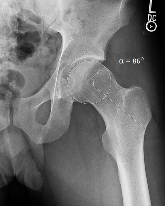 Dunn view of the left hip showing cam lesion and measured alpha angle of 86 degrees in a patient with femoroacetabular impingement