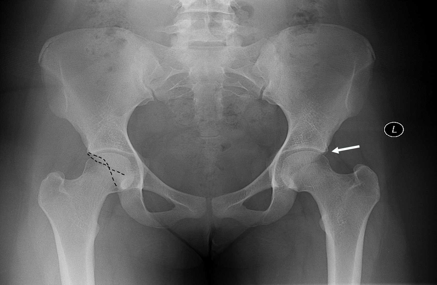 Pelvis x-ray demonstrating a pincer lesion of the left hip (indicated by white arrow)