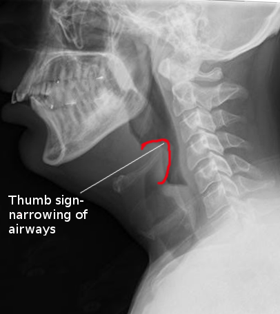 <p>Epiglottis, Lateral X-Ray. The thumb-sign narrowing of the airway is denoted by the arrow.</p>