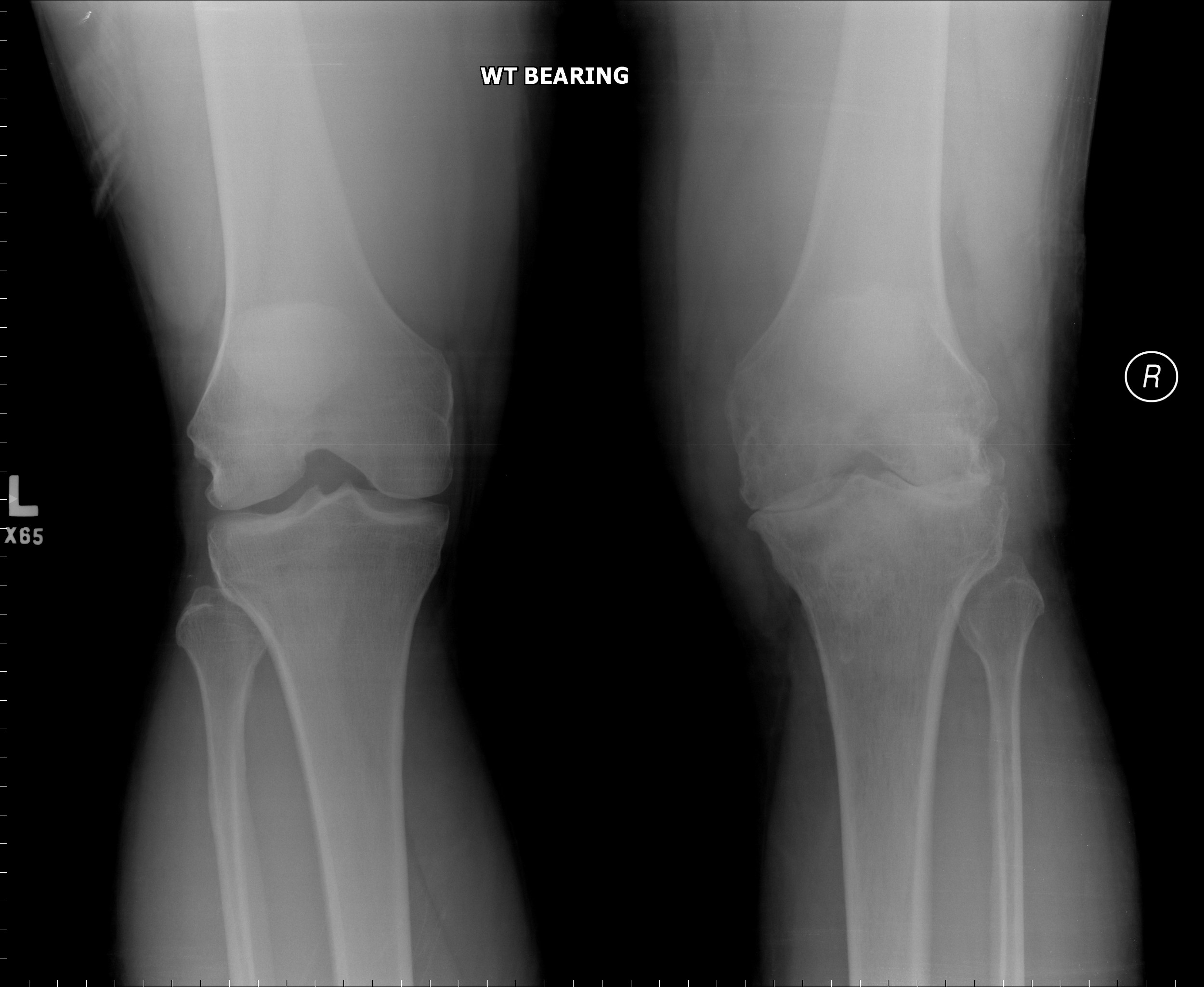 Frontal view of the knees in this patient with right sided knee pain and swelling