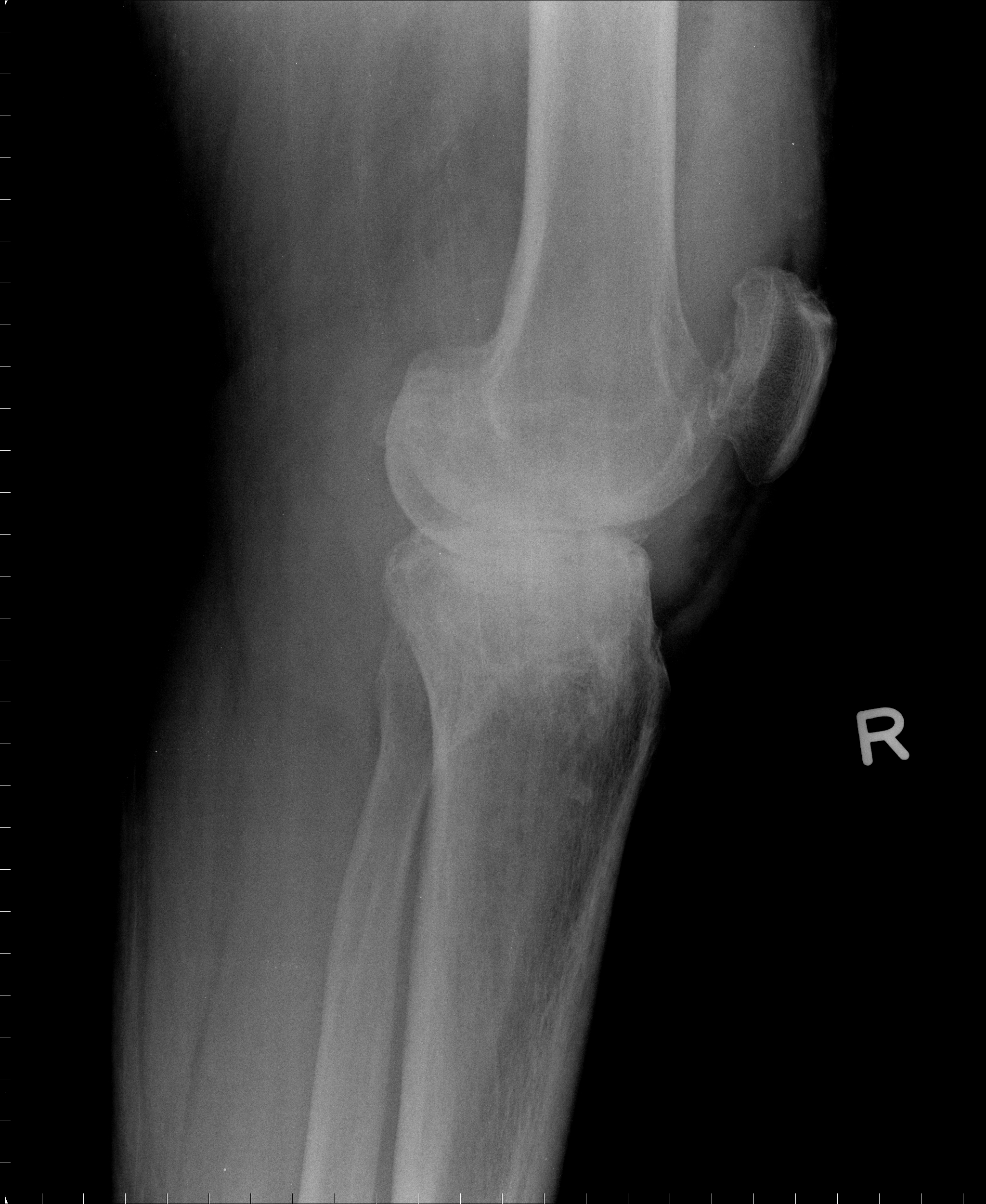 Lateral view of the knee in this patient with swelling, demonstrating erosions, a large high density joint effusion suggestive of pigmented villonodular synovitis (PVNS)