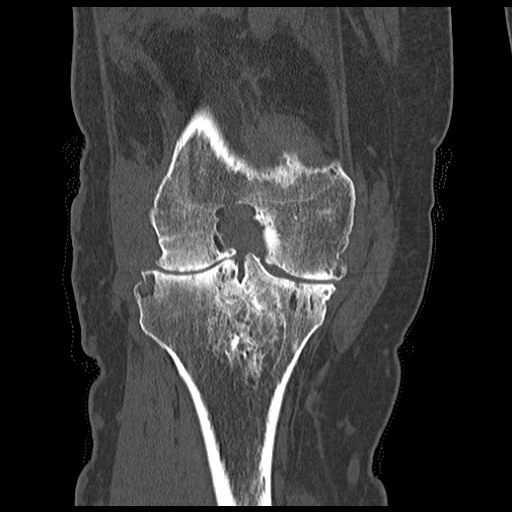 Coronal CT image in a patient with knee swelling demonstrating erosions and a joint effusion due to pgimented villonodular synovitis (PVNS)