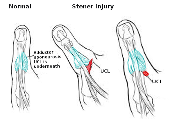 Stener Injury