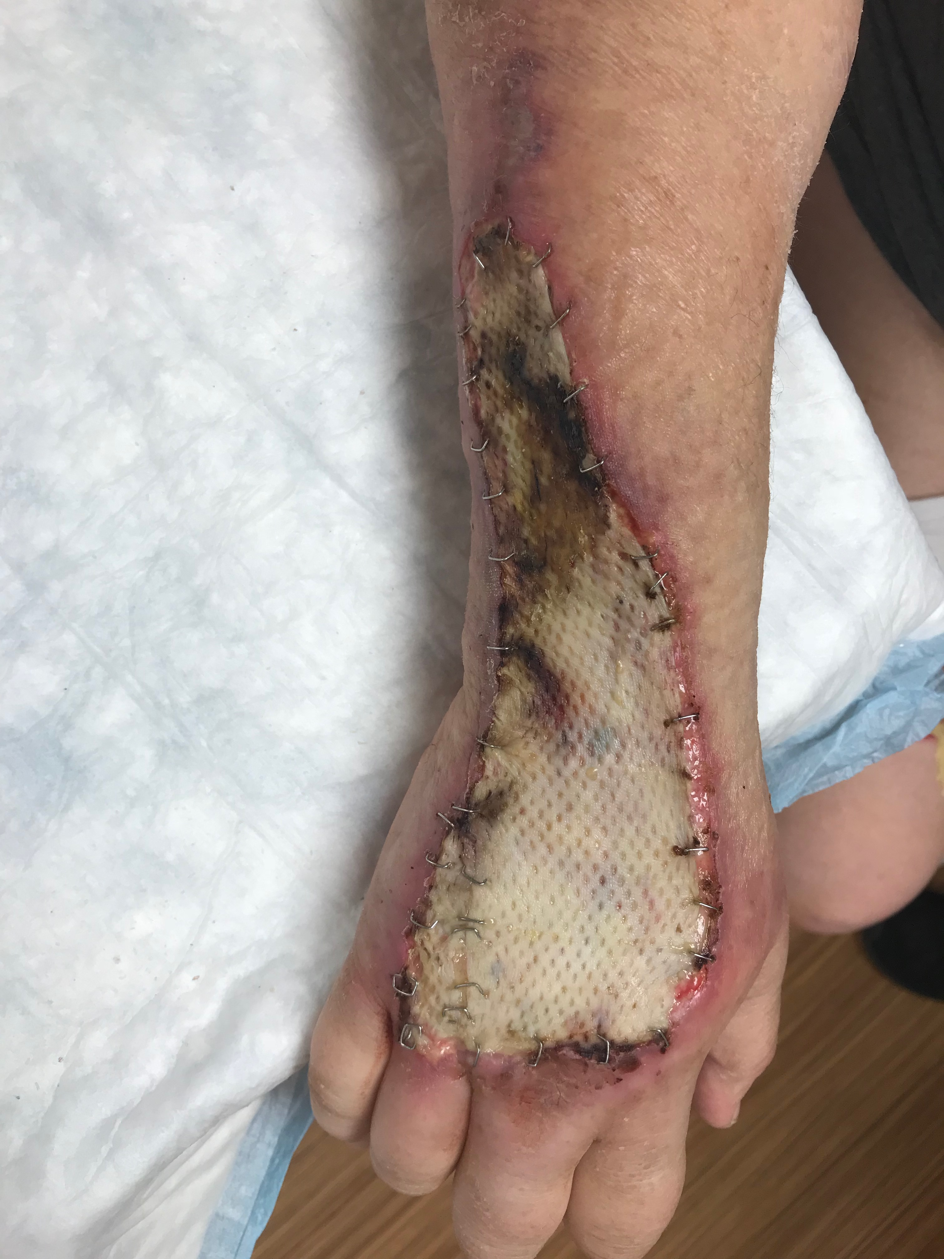 Non-viable split-thickness skin graft to right dorsal hand and wrist.
