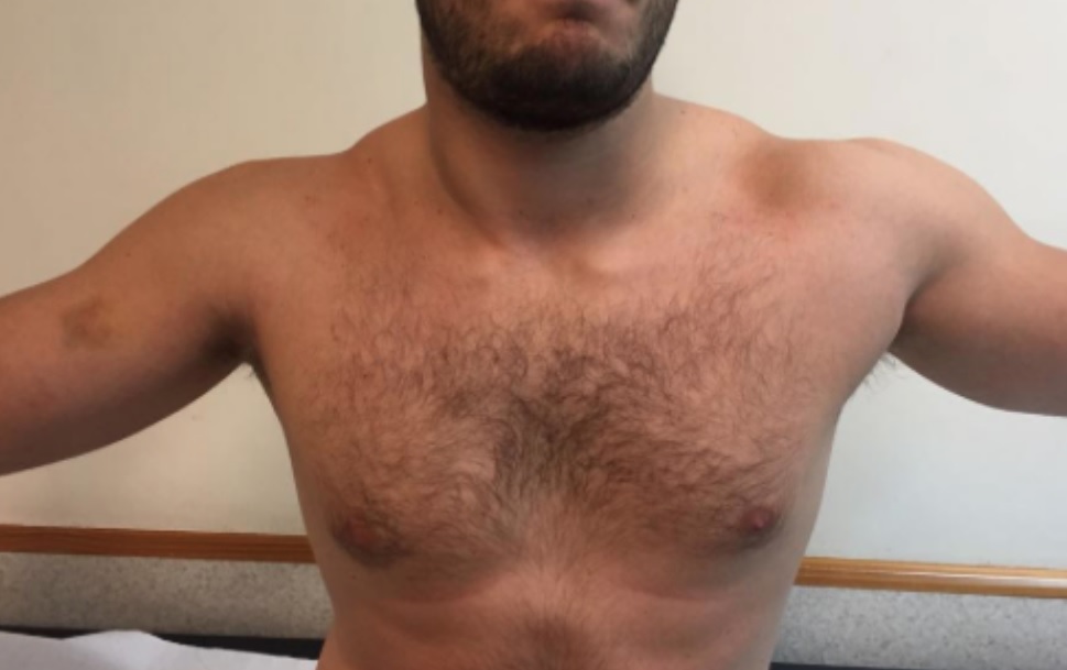 Clinical image showing a patient with a right Pectoralis major tear