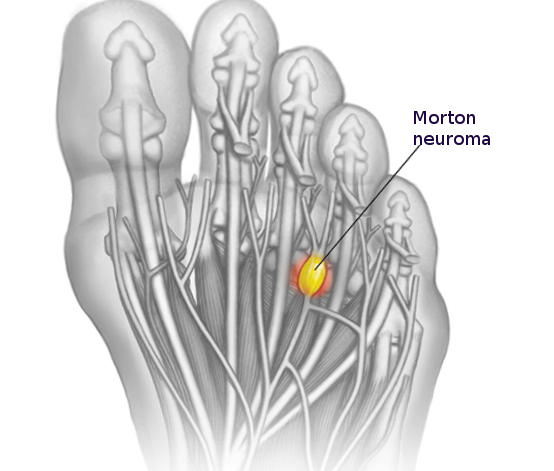 <p>Morton Neuroma</p>