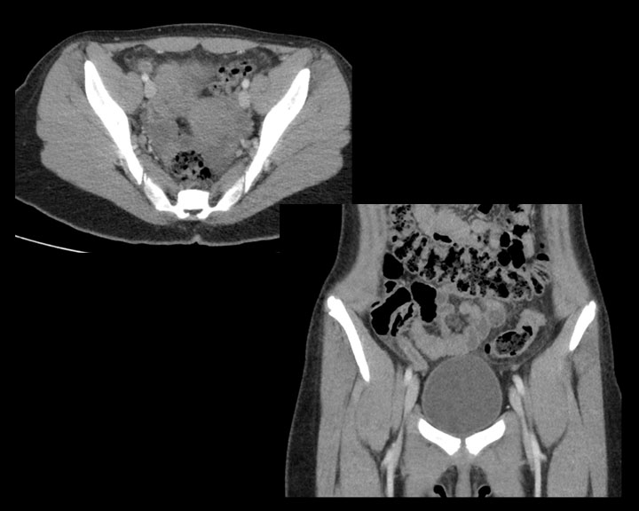 CT of early acute appendicitis