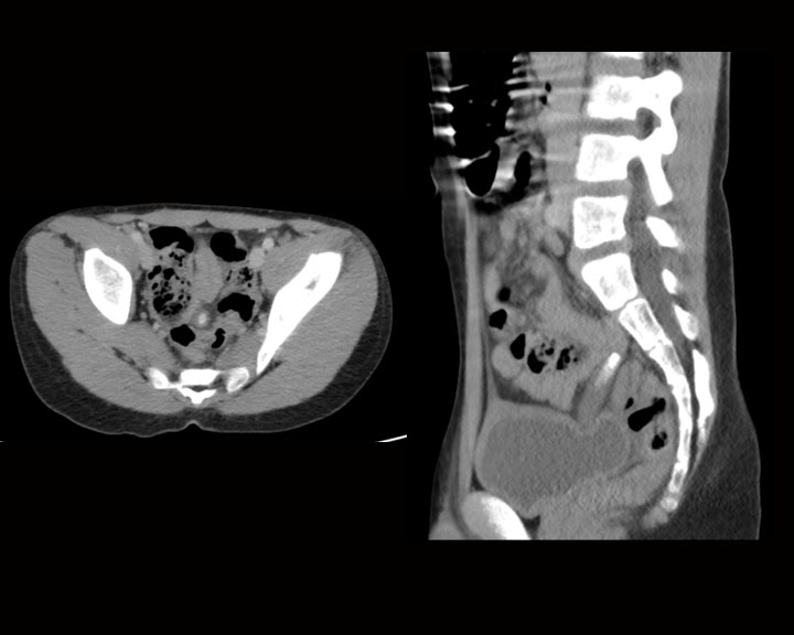 Early acute appendicitis with the dilated fluid filled appendix containing an appendicolith, the appendix is sitting on the urinary bladder