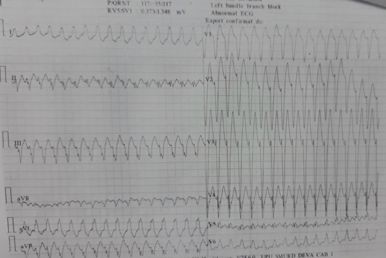 <p>Ischemic Ventricular Tachycardia in a Patient With an Old Inferior Myocardial Infarction.</p>