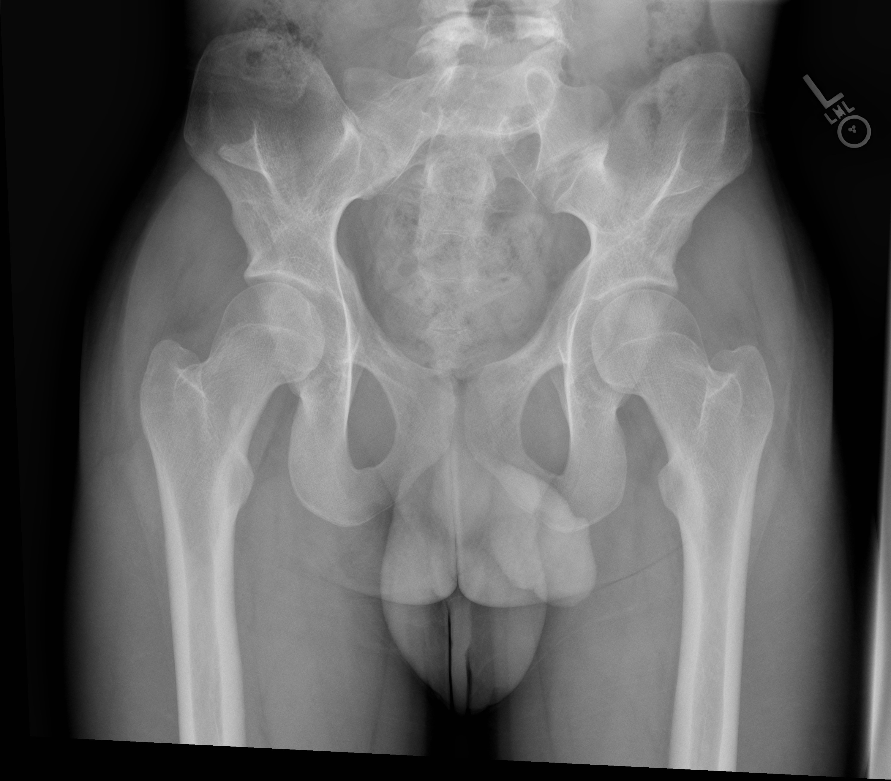 Radiographic single frontal anteroposterior (AP) view of the pelvis shows symmetric osseous processes of the bilateral iliac bones