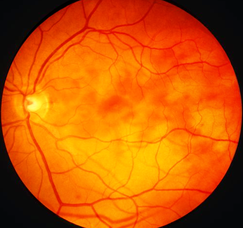CMV retinitis