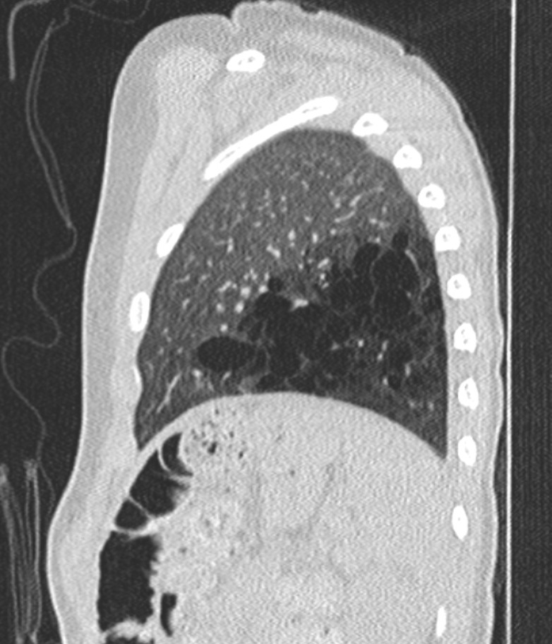 CT chest image (sagittal view) showing left lower lobe CPAM