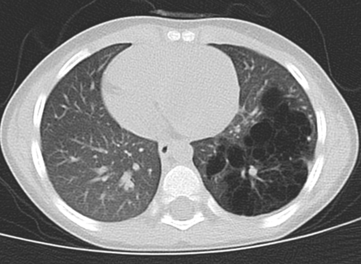 CT chest (coronal view) showing left lower lobe CPAM