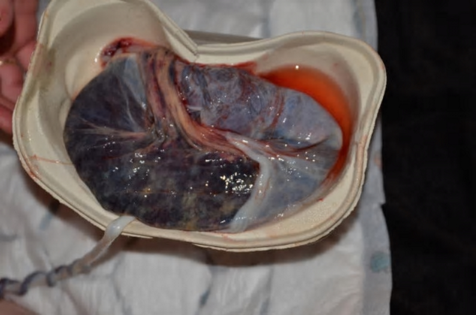 The figure shows a human placenta.