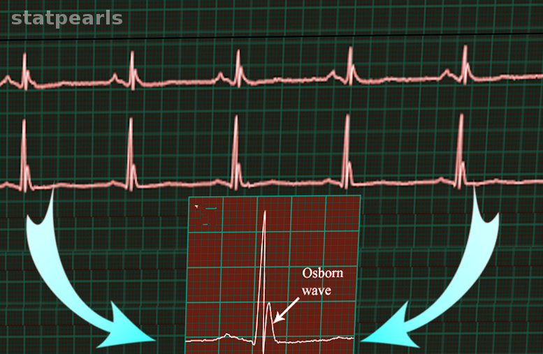 <p>Osborn Wave On Electrocardiography. This electrocardiogram (ECG) strip shows Osborn waves.</p>