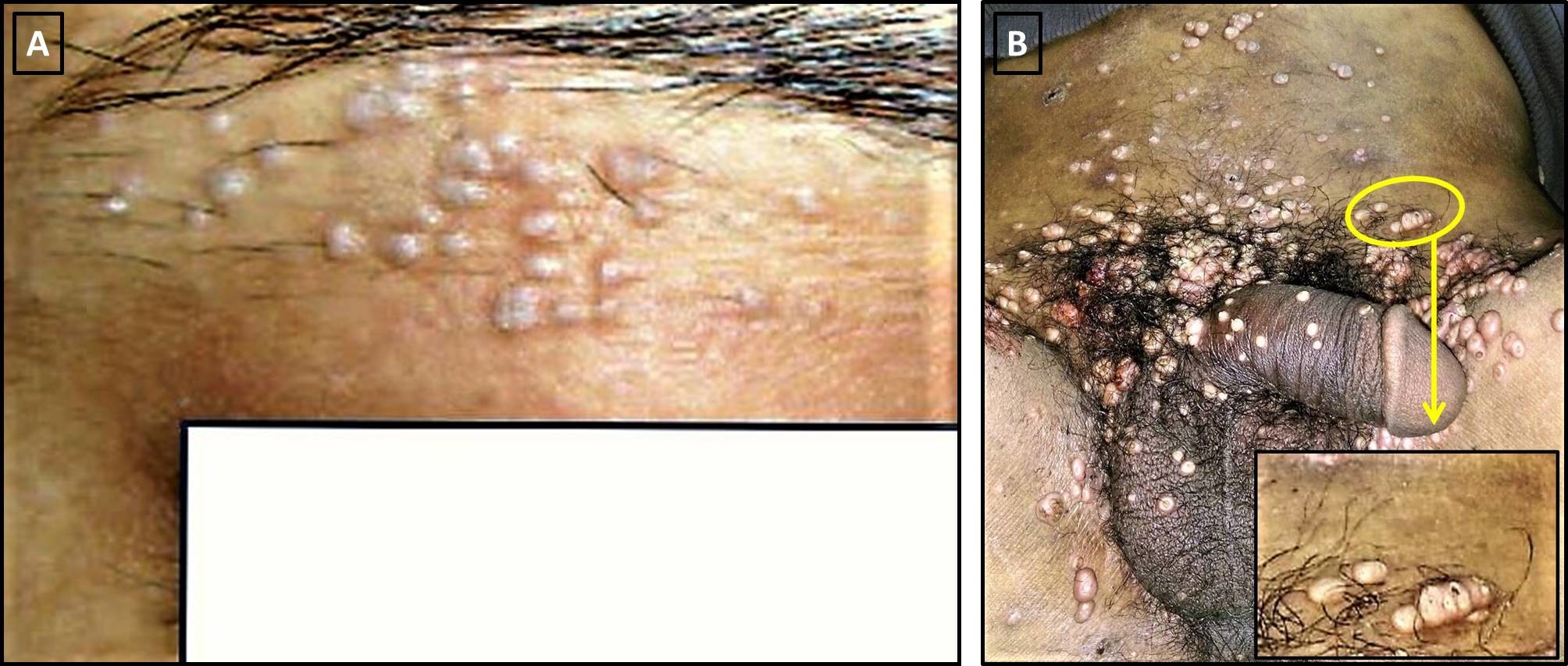 Figure 2 Pseudokoebnerization: (A) Of flat warts in the threading area of a young lady; and (B) Ofmolluscum contagiosum (MC) lesions in an immunosuppressed patient