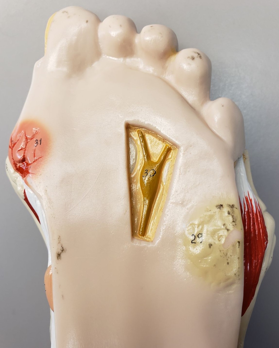 Diabetic foot model showing full-thickness ulceration on far left side of picture, and pre-ulcerative lesion on far right.