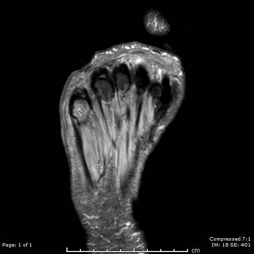 T2-weighted MRI image of a patient's right foot