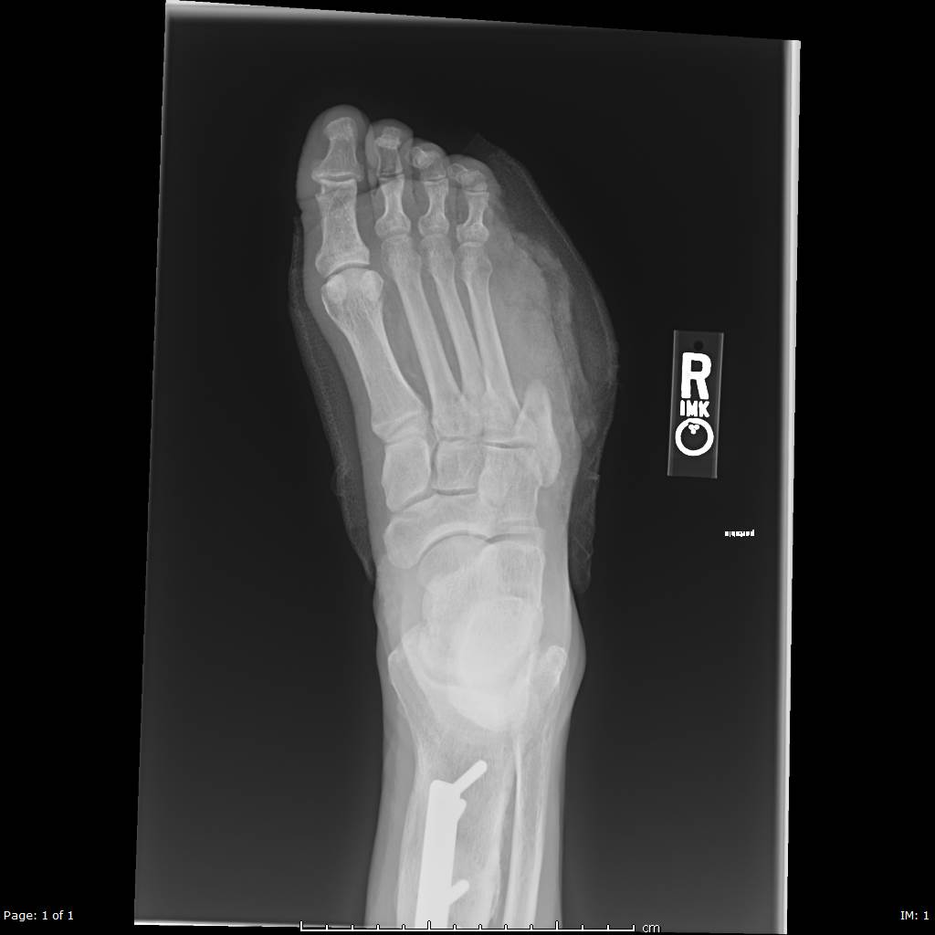Xray of a patient's right foot after undergoing partial ray resection of the 5th metatarsal for acute osteomyelitis