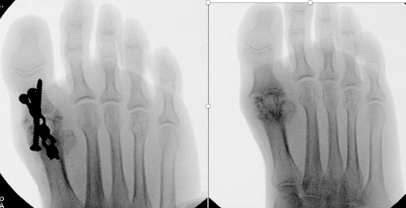 <p>Hallux Rigidus Plate.&nbsp;AP x-ray of severe hallux rigidus requiring surgical plate placement.</p>