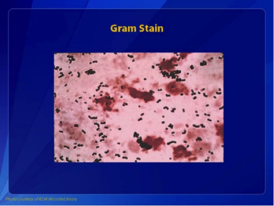 Figure 2: Gram stain of group B streptococcus showing gram-positive cocci in pairs and chains.