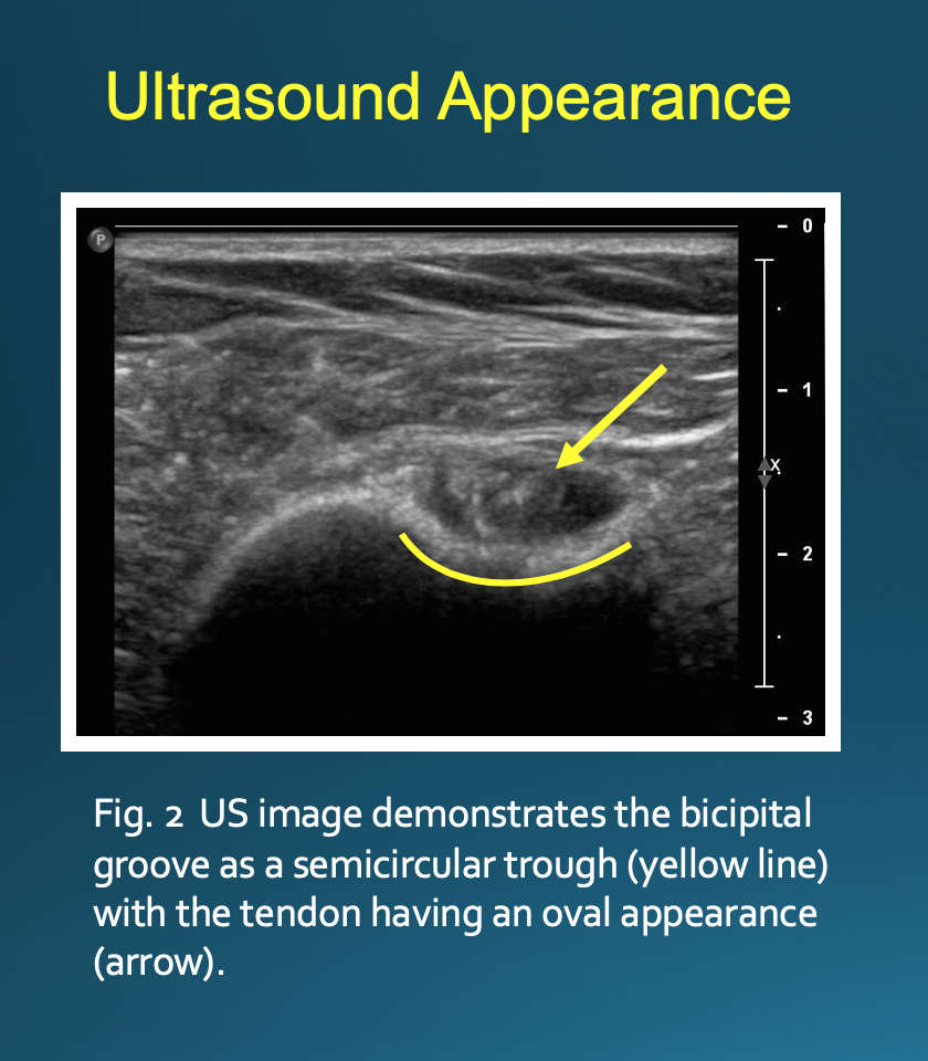 <p>Ultrasound Appearance. US-guided biceps tendon sheath injection.</p>
