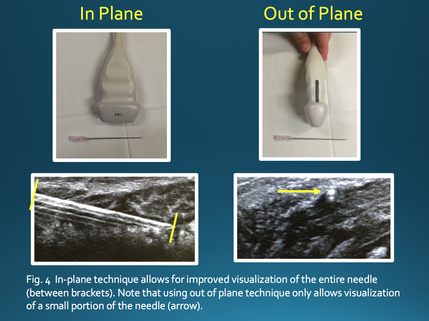 <p>Ultrasound&nbsp;Techniques. in-plane technique versus out-of-plane technique.</p>