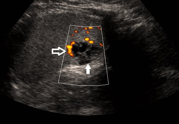 <p>Ultrasound of the Spleen