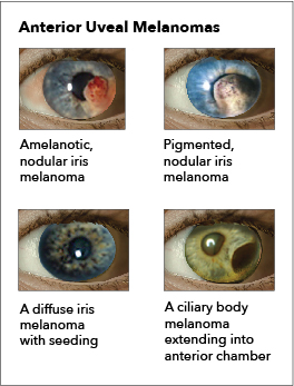 <p>Ocular Melanoma. The image depicts various presentations of anterior uveal melanoma.</p>