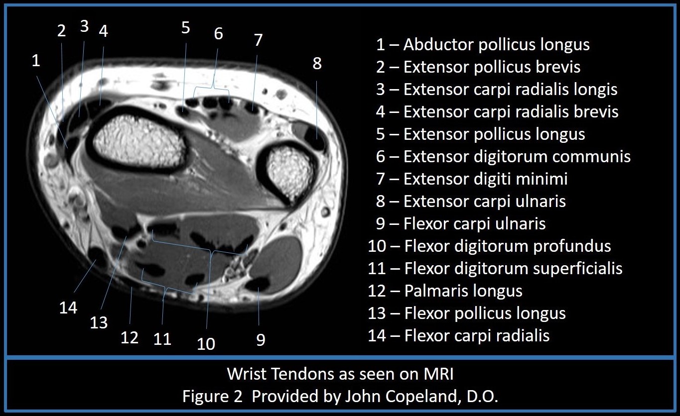 Wrist MRI with labeled tendons