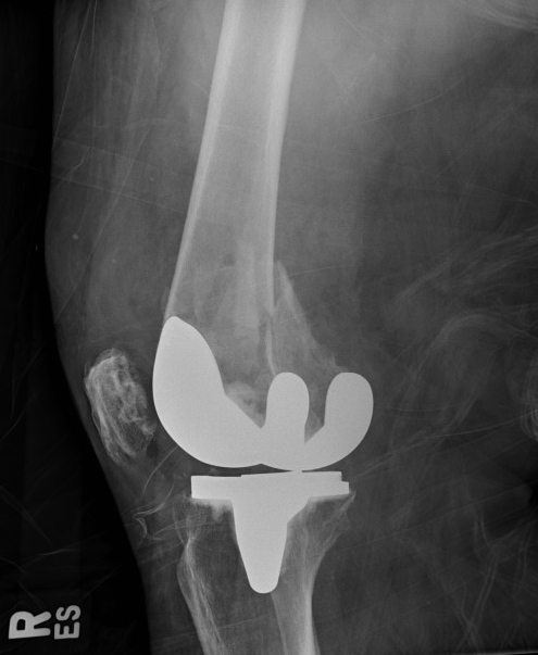 Lateral view of a periprosthetic distal femur fracture about a cemented cruciate retaining total knee arthroplasty