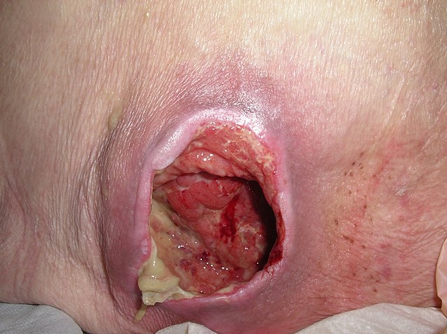 <p>Stage 4 Ulcer</p>