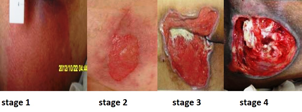 <p>Stages of Ulcers</p>