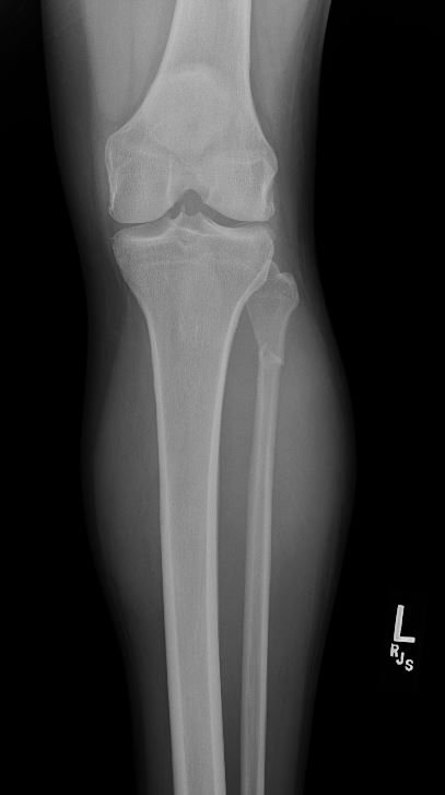 AP image of a minimally displaced left proximal fibula fracture