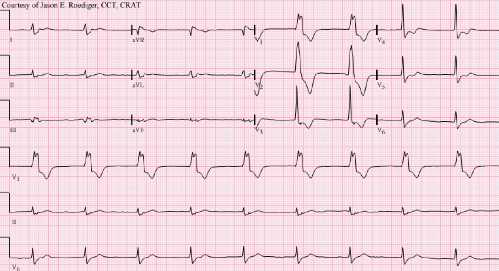 Accelerated idioventricular rhythm (AIVR) at a rate of 55/min presumably originating from the left ventricle (LV)
