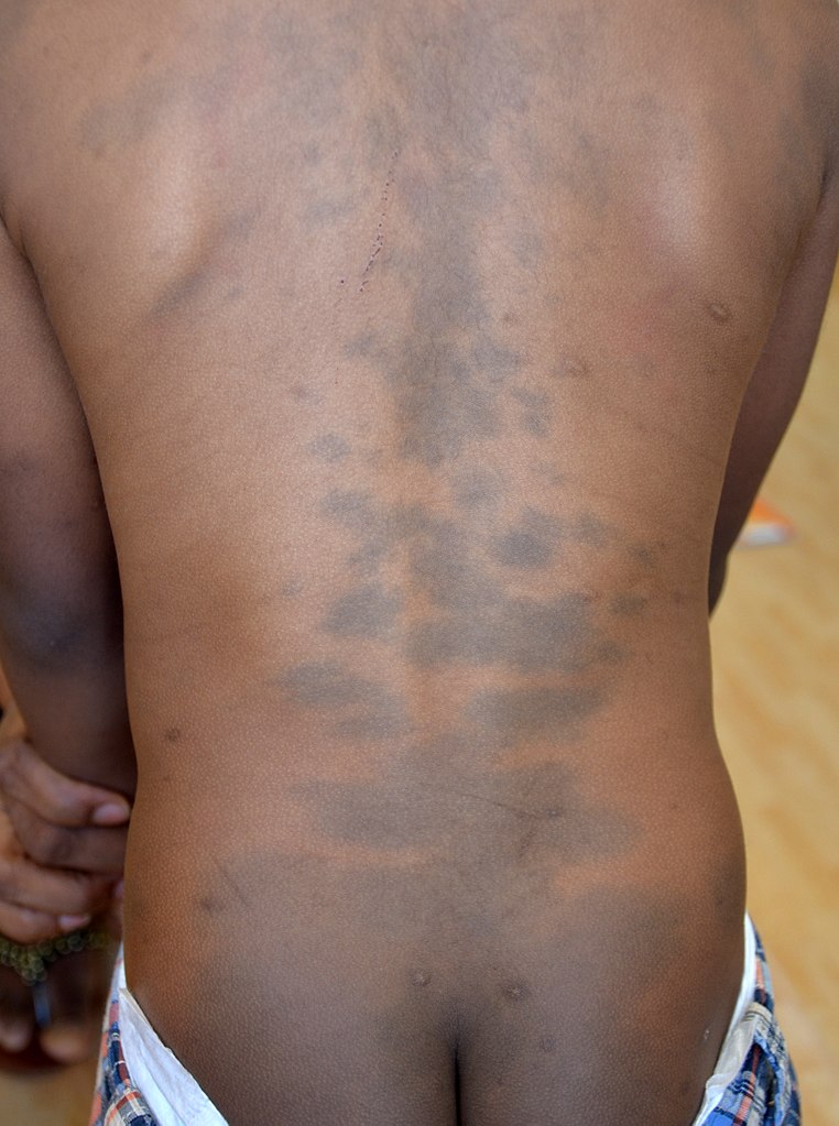 <p>Giant Blue Nevus. Giant blue nevus (giant Mongolian blue spot) on the back and buttocks of an African boy.</p>