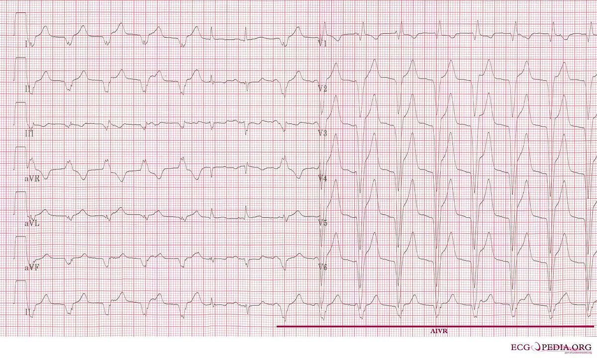 EKG showing accelerated idioventricular rhythm in a patient who was treated with primary PCI.