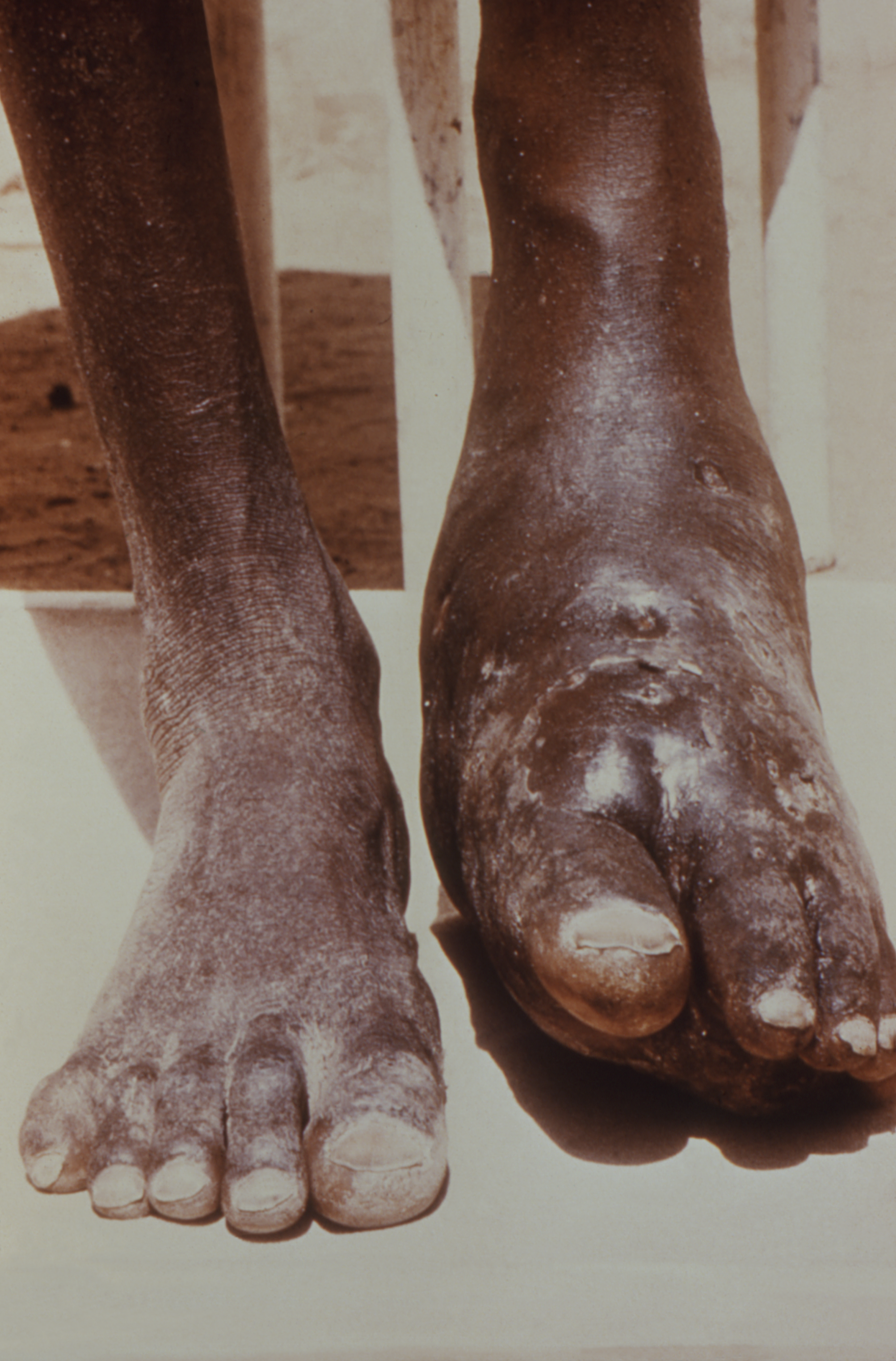 This image depicts the feet, ankles, and lower legs of a patient, who had presented with an infection known as nocardiosis, a form of actinomycosis, due to the bacterium, Nocardia somaliensis, which had affected the left foot and ankle, causing severe swelling and deformation of the normal structural contours