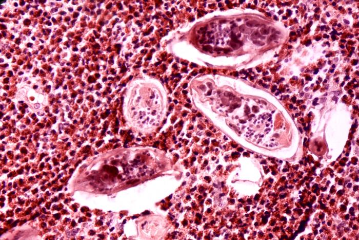 This photomicrograph depicts some of the histopathologic details seen in a bladder tissue specimen, in a case of schistosomiasis haematobium, also known as urinary blood fluke, caused by the parasitic flatworm, Schistosoma haematobium