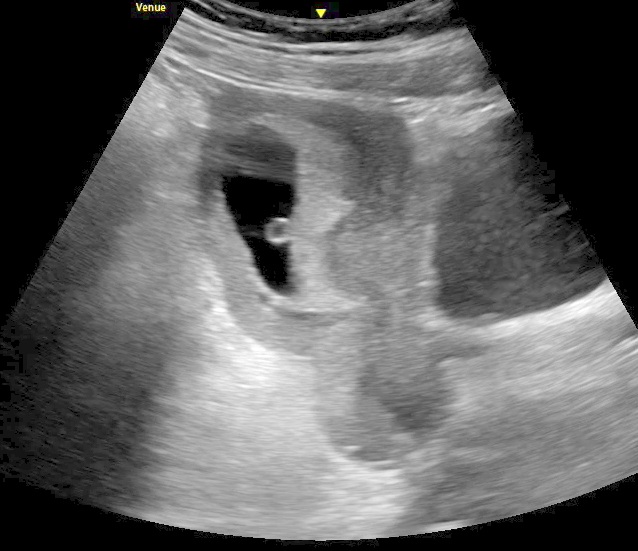 <p>Intrauterine Pregnancy With a Yolk Sac