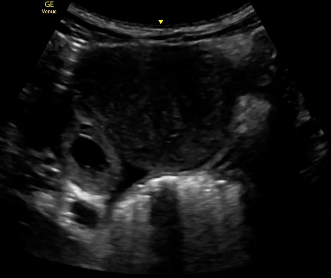 <p>Ectopic Pregnancy, Ultrasound. This image demonstrates an ectopic pregnancy via ultrasound.</p>