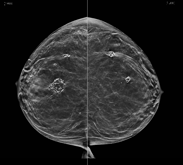 Benign breast calcification: Dystrophic calcifications from fat necrosis are seen within both breasts.