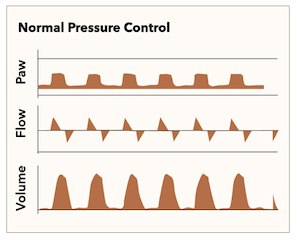 Ventilator waveforms of pressure control ventilation. This demonstrates an optimized waveform.