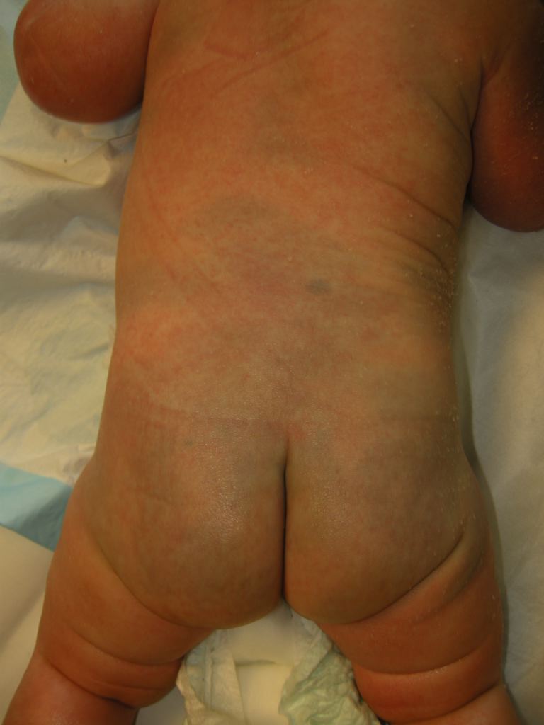 <p>Congenital Dermal Melanocytosis (Mongolian Spot)</p>
