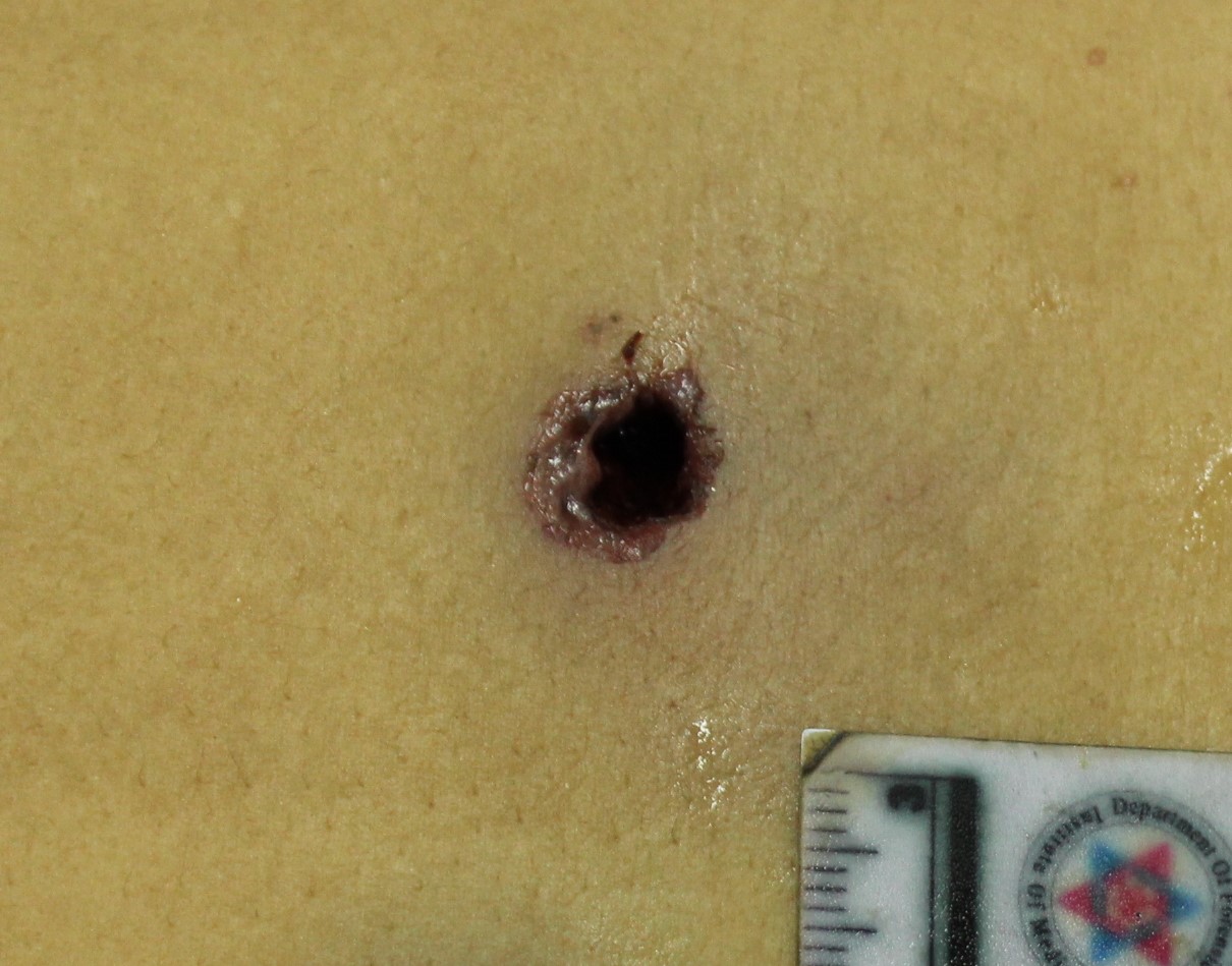 Figure 1 - Entry wound of a rifled small arm (revolver) showing the abrasion collar