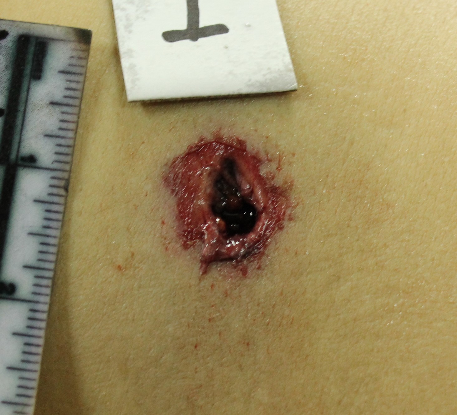 Figure 2 - Exit wound from a rifled small arm (revolver) showing larger injury, in comparison with the entry wound