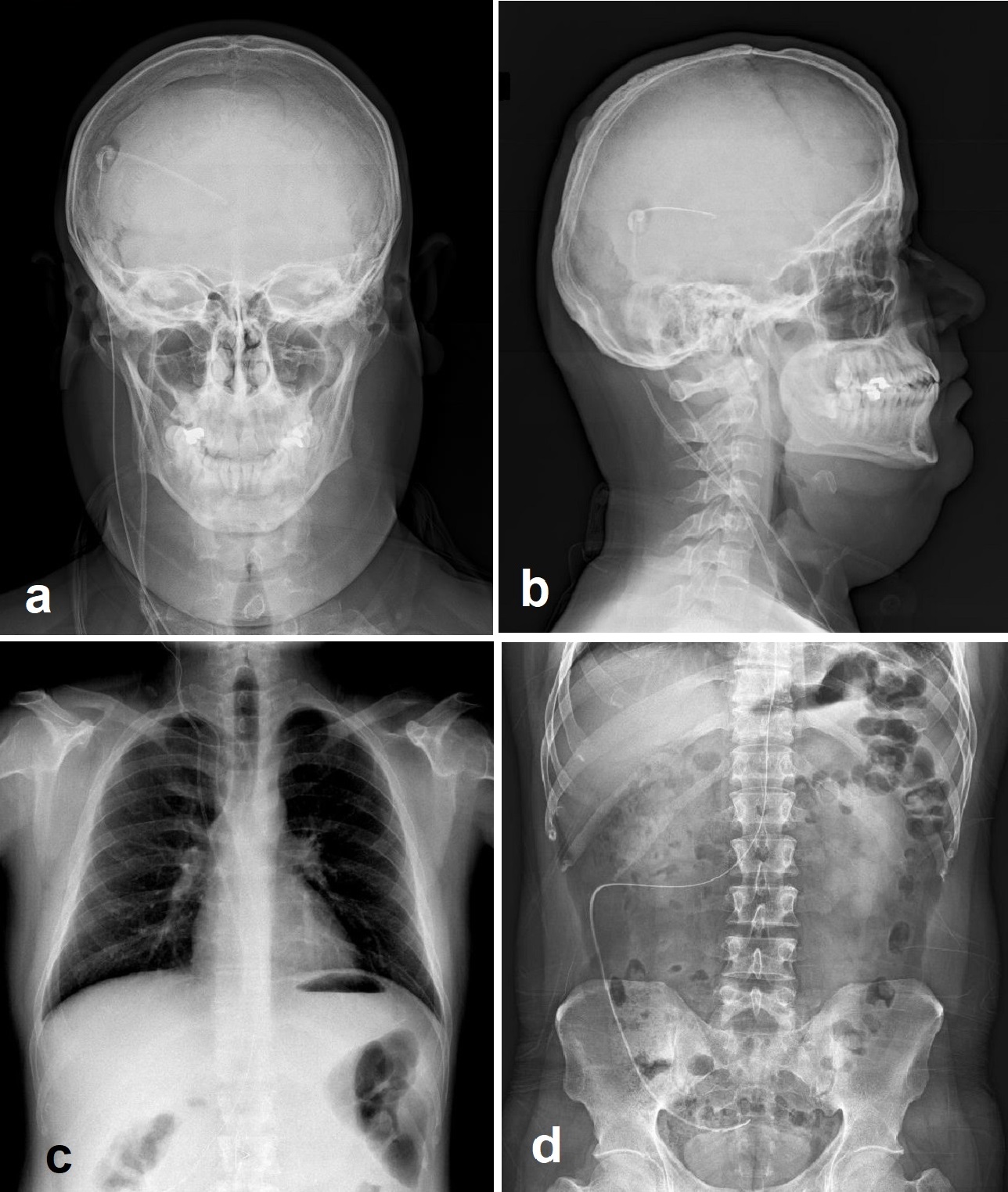 Shunt series including biplanar head (a and b), anteroposterior chest (c) and anteroposterior abdominal (d) radiographs demonstrating the ventriculoperitoneal shunt catheter throughout its course