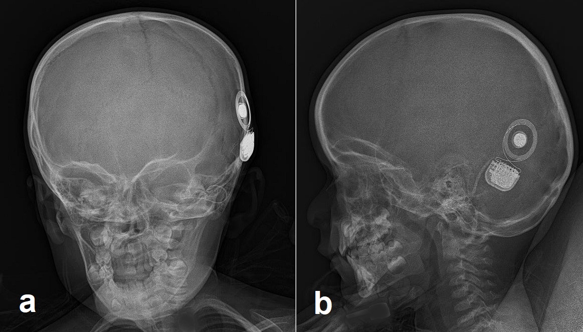 Anteroposterior (a) and lateral (b) skull radiographs showing cochlear implant components within the left inner ear and on the left temporal bone