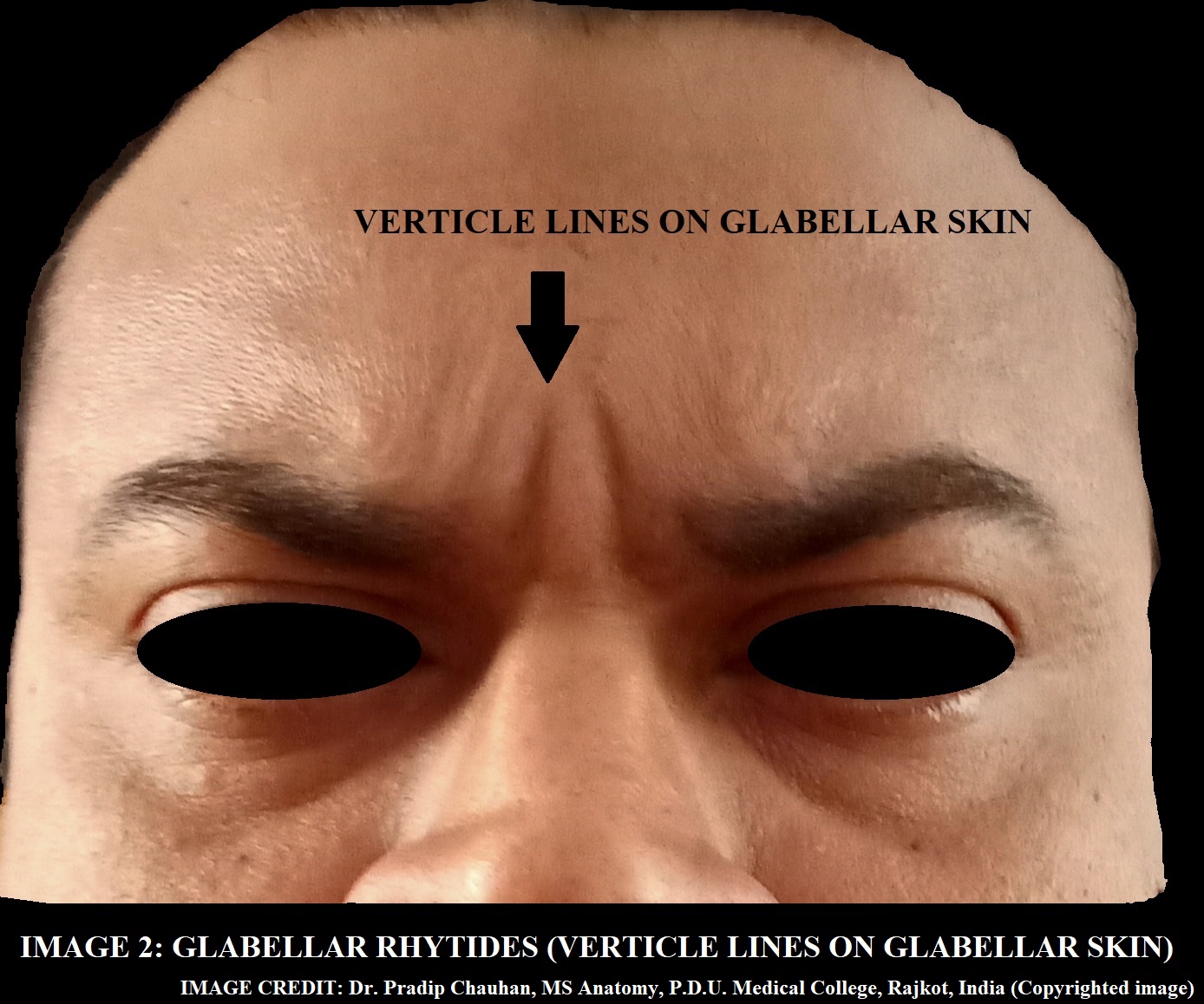 VERTICAL GROOVES ON GLABELLAR SKIN ON MOVEMENT OF EYEBROW.