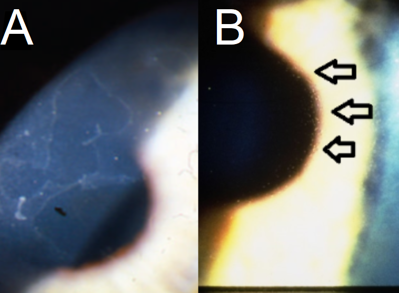 A: Epithelial Basement Membrane Corneal Dystrophy (Map Dot Fingerprint Dystrophy) presents with geographic, map-like erosions on the corneal surface on biomicroscopy